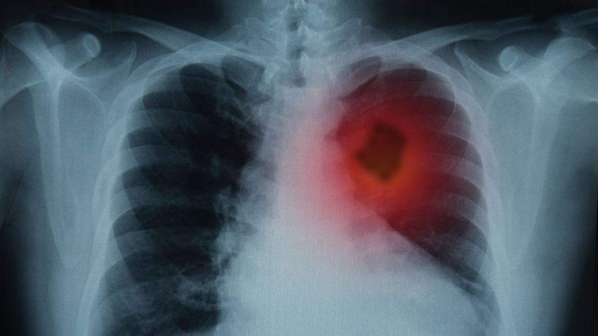 Рак легень – стадії, симптоми і які шанси на виживання