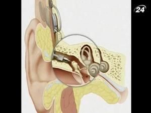 Первый слуховой аппарат предназначен для имплантации в голову