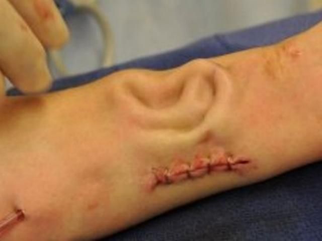 Лікарі виростили пацієнтці нове вухо в її руці Лікарі виростили пацієнтці нове вухо в її руці