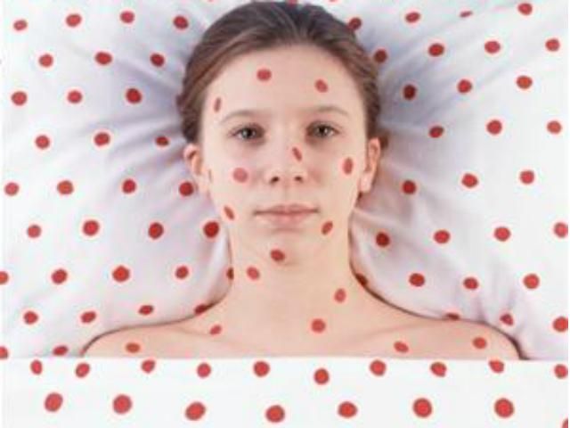 Епідеміологи: В Україні зростатиме кількість хворих на кір Епідеміологи: В Україні зростатиме кількість хворих на кір