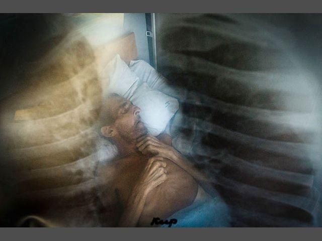 В Україні не вщухає епідемія туберкульозу (Фото)