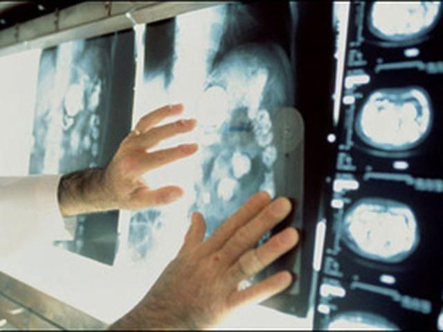 Онколог у Британії зробив операції тисячі здорових жінок Онколог у Британії зробив операції тисячі здорових жінок