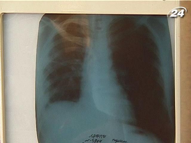 На Донетчине заболеваемость туберкулезом снизилась на 30% На Донетчине заболеваемость туберкулезом снизилась на 30%