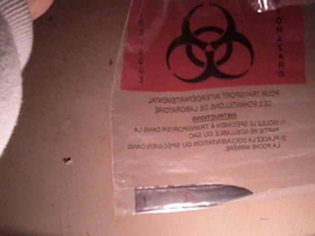 У Сальвадорі чоловік прожив 17 років з ножем у голові У Сальвадорі чоловік прожив 17 років з ножем у голові