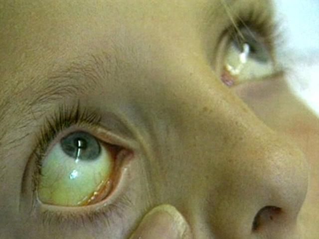 В Украине почти 4 миллиона человек больны гепатитами В и С В Украине почти 4 миллиона человек больны гепатитами В и С