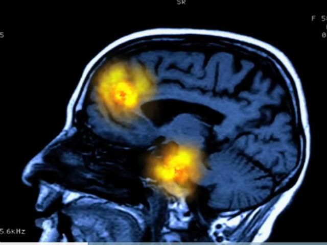Факти про здоров'я: деменція або старече слабоумство Факти про здоров'я: деменція або старече слабоумство