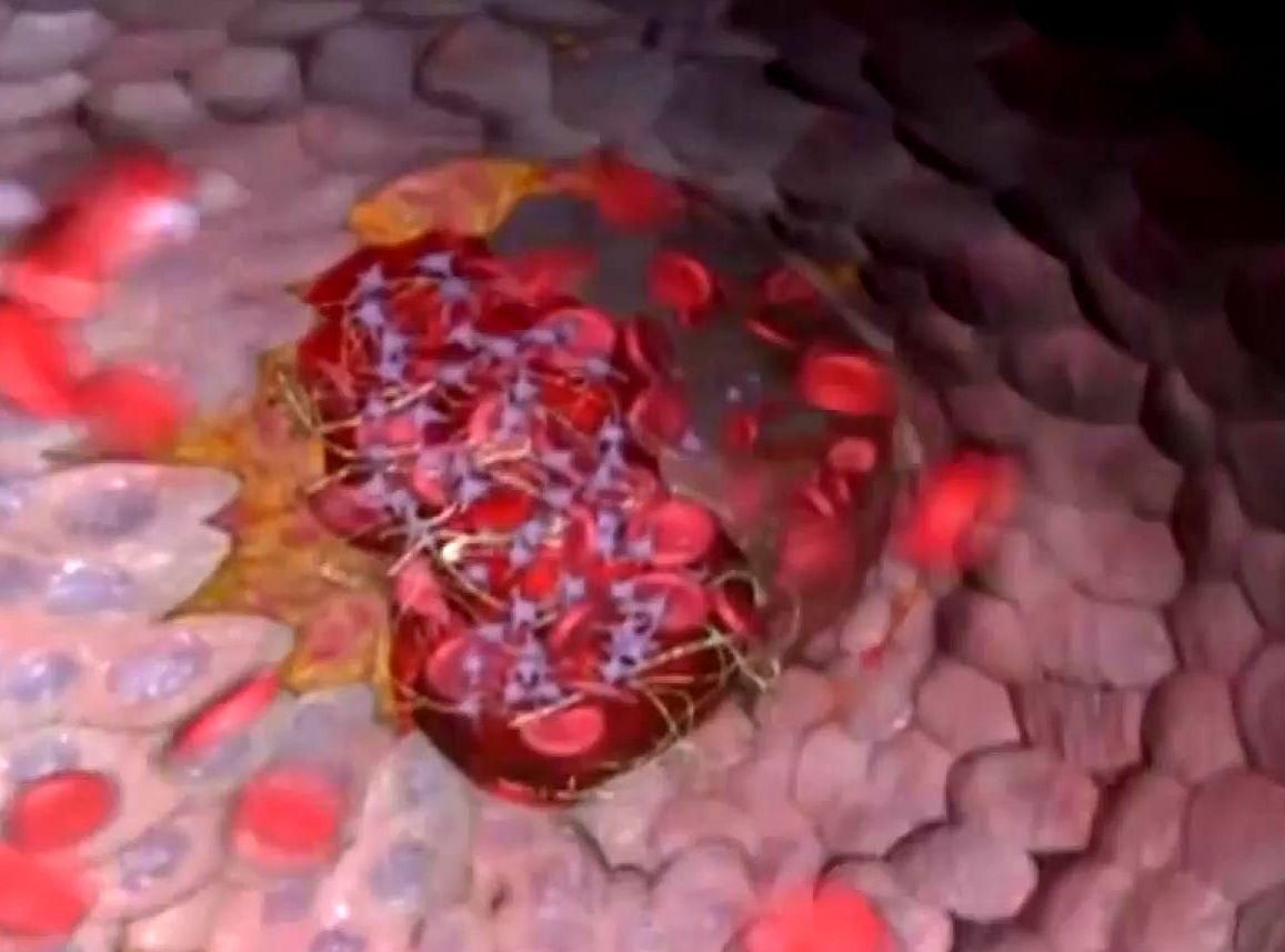 Факти про здоров'я. Симптоми Інфаркту міокарда Факти про здоров'я. Симптоми Інфаркту міокарда