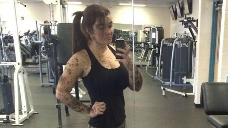 Дівчина з рідкісною хворобою шкіри пишається свою унікальністю Дівчина з рідкісною хворобою шкіри пишається свою унікальністю