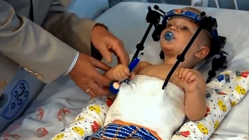 Австралійські лікарі пришили дитині відтяту голову після ДТП