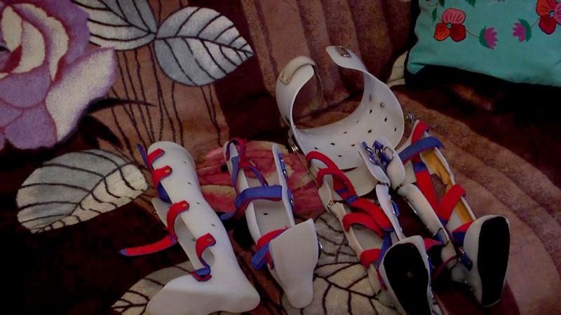 Рідкісне захворювання змушує дитину носити обтяжливі обладунки Рідкісне захворювання змушує дитину носити обтяжливі обладунки