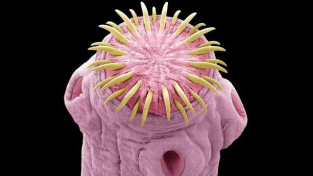 Из головы мужчины извлекли живого паразита