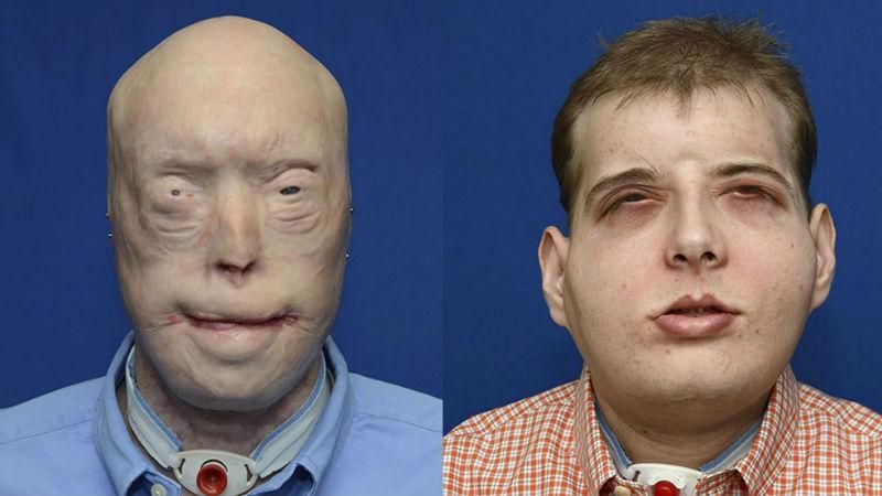 Американські лікарі "подарували" нове обличчя пожежнику, а Microsoft вчитеме програмуванню дітей Американські лікарі "подарували" нове обличчя пожежнику, а Microsoft вчитеме програмуванню дітей