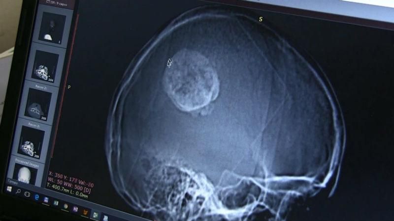 Украинские нейрохирурги провели сверхсложную операцию на мозг Украинские нейрохирурги провели сверхсложную операцию на мозг