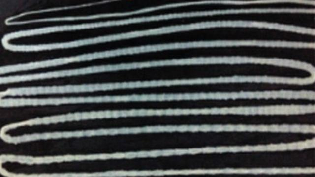 Медики вытащили из живота мужчины 6-метрового монстра