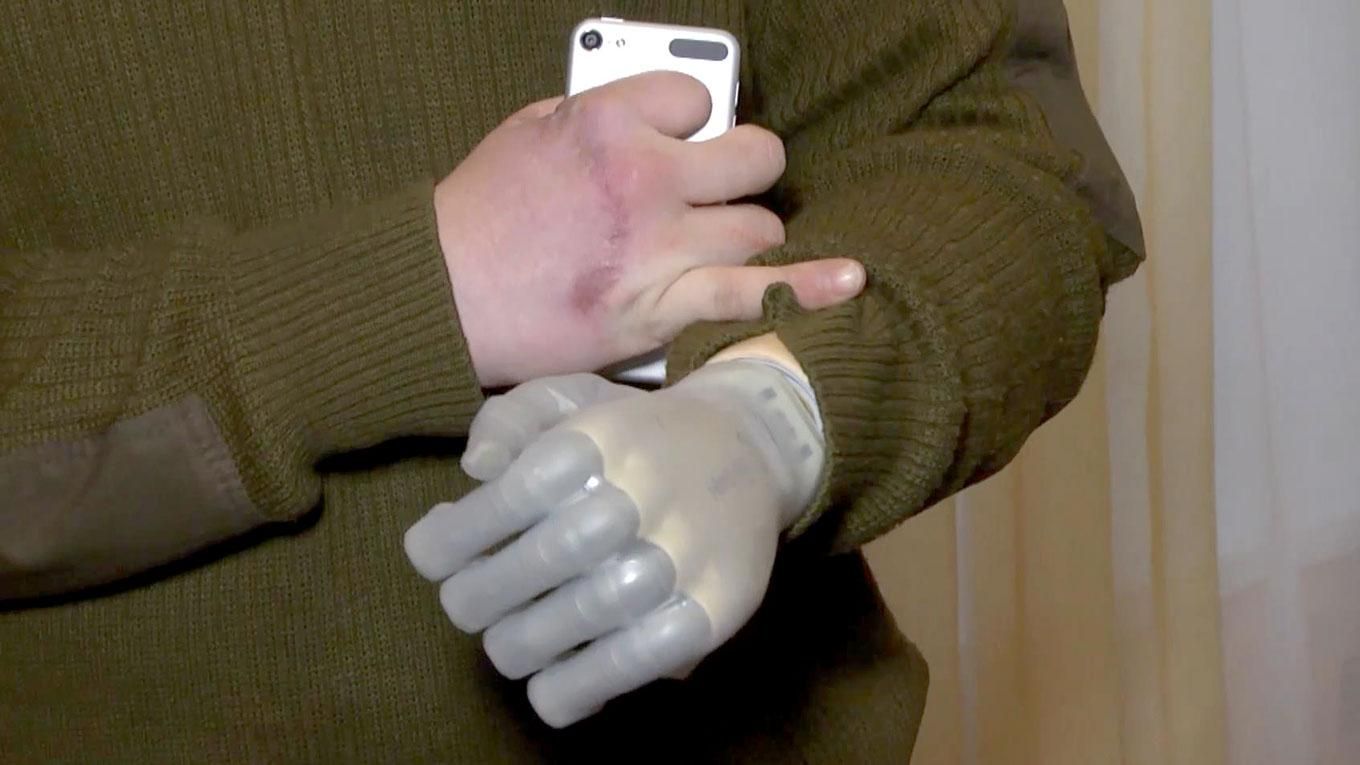 Майдановец бесплатно получил дорогой протез Майдановец бесплатно получил дорогой протез