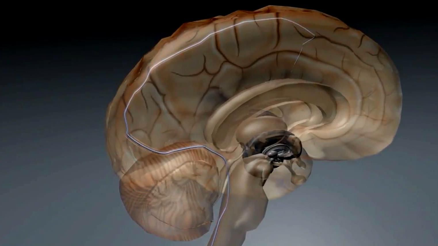 Медики винайшли пристрій, що дозволить керувати пристроями силою думки Медики винайшли пристрій, що дозволить керувати пристроями силою думки