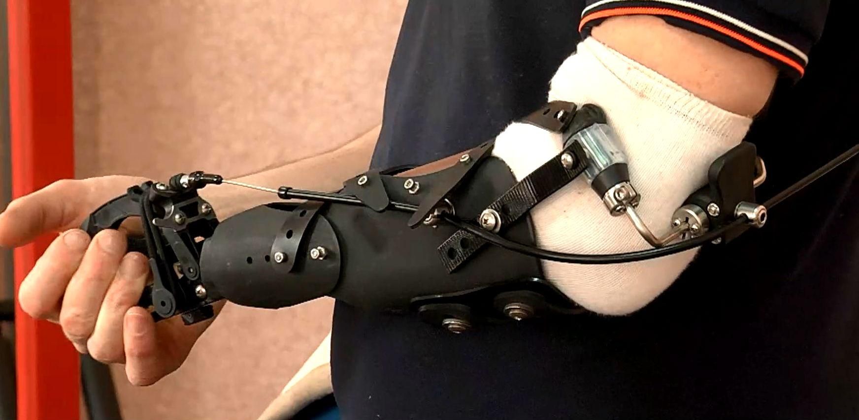 Іноземні лікарі показали "розумні" протези для бійців АТО Іноземні лікарі показали "розумні" протези для бійців АТО