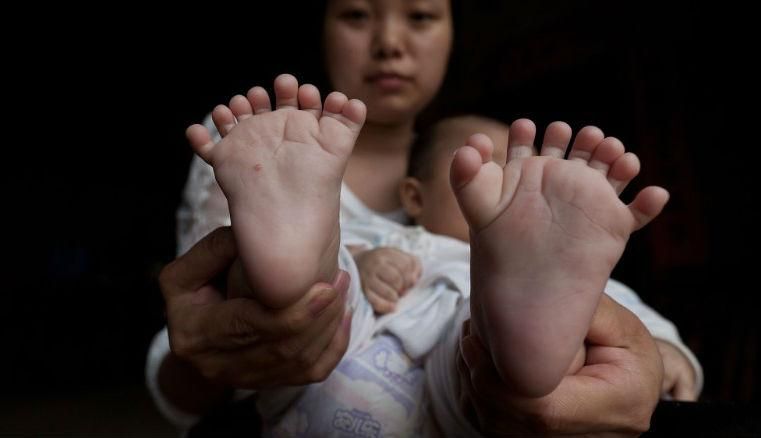 Аномалия: в Китае мальчик родился с тридцатью пальцами