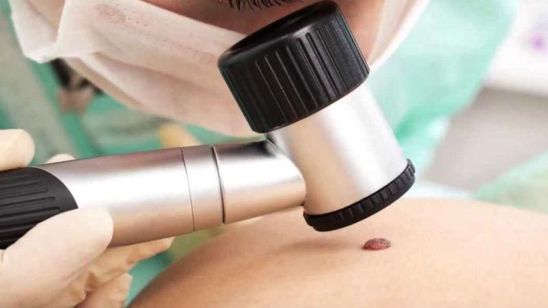 Яка родимка може перерости у меланому Яка родимка може перерости у меланому