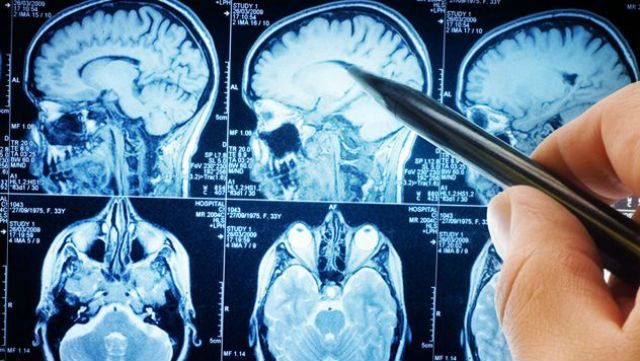 Ученые заявили, что высшее образование увеличивает риск рака мозга