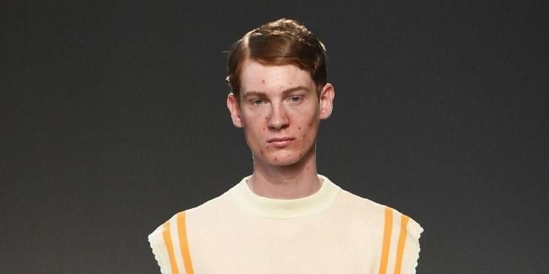 Бути прищавим тепер не соромно: тиждень моди в Мілані відкрив новий тренд Бути прищавим тепер не соромно: тиждень моди в Мілані відкрив новий тренд