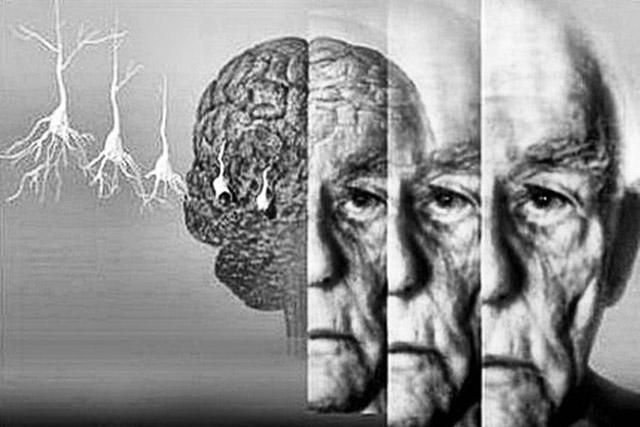 Вчені зробили нове відкриття у сфері лікування хвороби Альцгеймера
