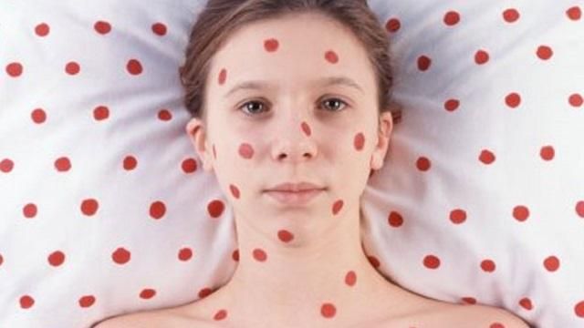 В этом году в Украине ожидается эпидемия кори, – эксперт В этом году в Украине ожидается эпидемия кори, – эксперт