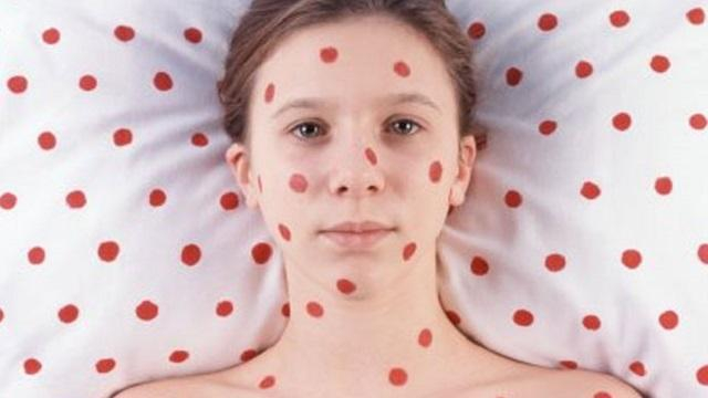 В этом году в Украине ожидается эпидемия кори, –  эксперт