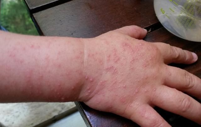 Лікар розповів, чим вилікувати дитину від вірусу Коксакі Лікар розповів, чим вилікувати дитину від вірусу Коксакі