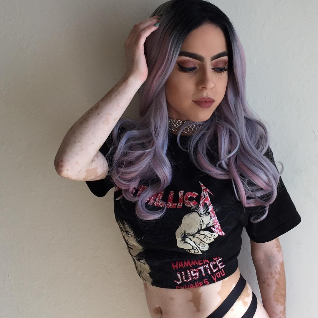 Девушка с редким заболеванием превратила свое тело в холст: фото