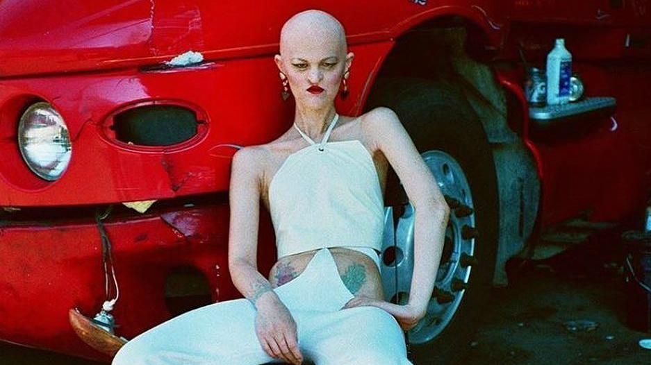 Дівчина з рідкісним захворювання перетворилась на ікону моди (18+) Дівчина з рідкісним захворювання перетворилась на ікону моди (18+)