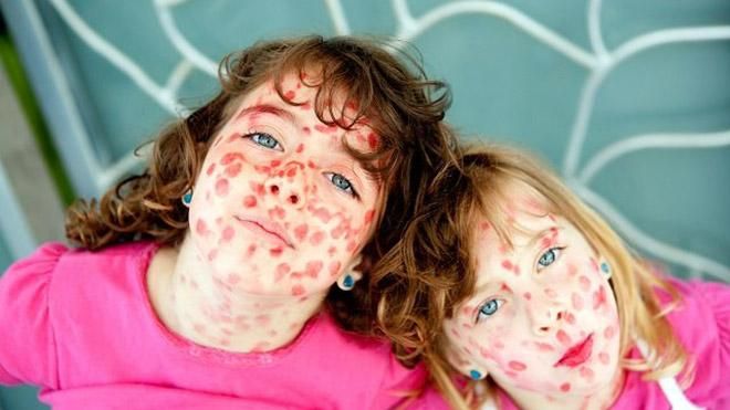 Корь в Украине: причины вспышки в 2017 году Корь в Украине: причины вспышки в 2017 году