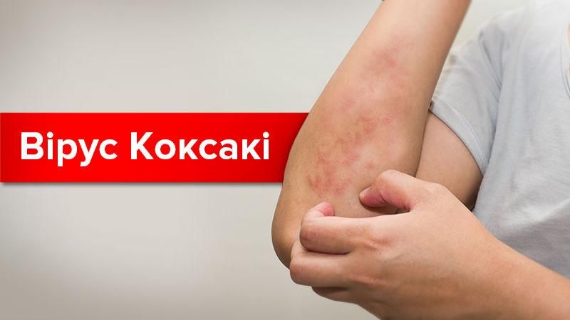 Вірус Коксакі в Україні: симптоми, шляхи зараження та лікування