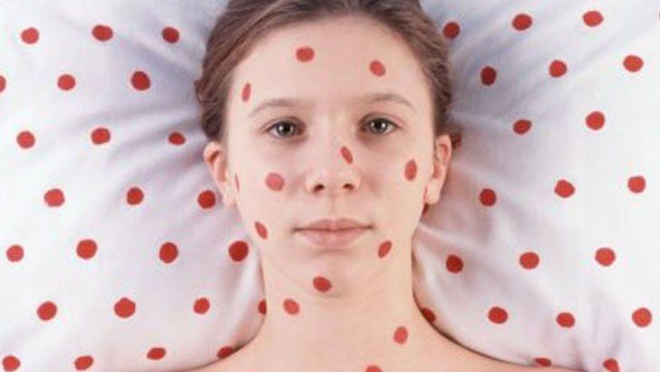 В Запорожье значительно возросло количество больных корью