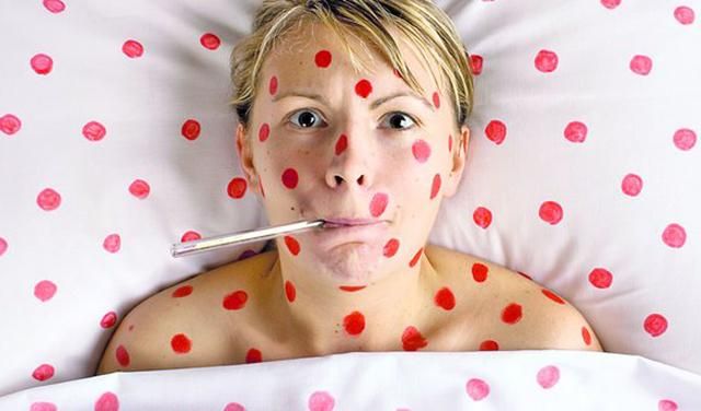 Эпидемия кори: количество больных в Запорожье перевалило за сотню Эпидемия кори: количество больных в Запорожье перевалило за сотню
