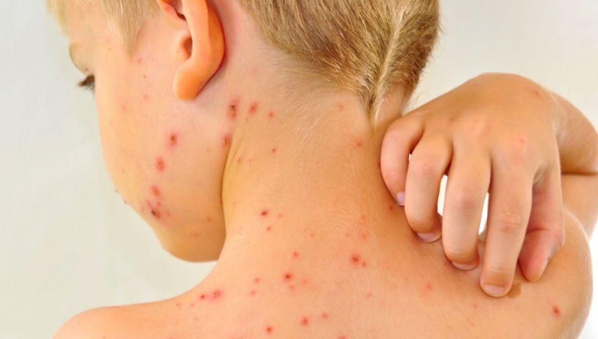 Корь в Украине: от кори умер 8 человек - новости Корь в Украине: от кори умер 8 человек - новости