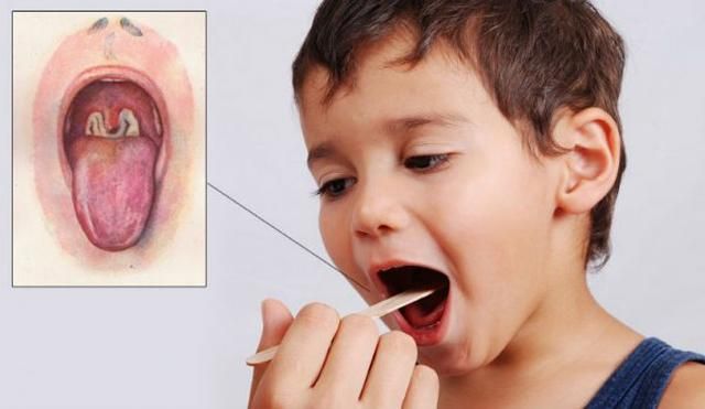 Дифтерия в Украине: Минздрав призывает делать прививку Дифтерия в Украине: Минздрав призывает делать прививку