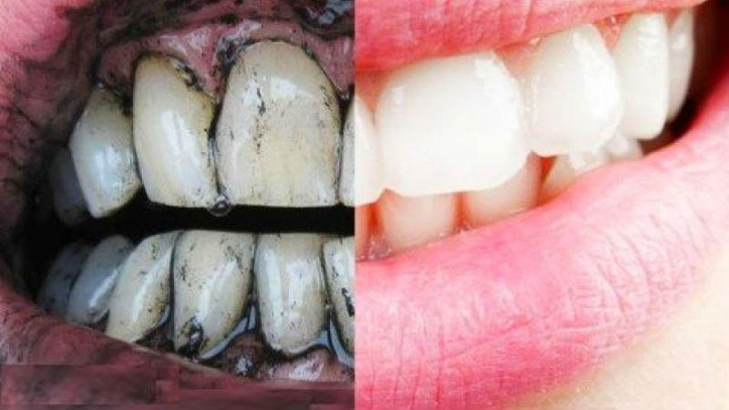 Стоматолог рассказал, почему опасно отбеливать зубы дома