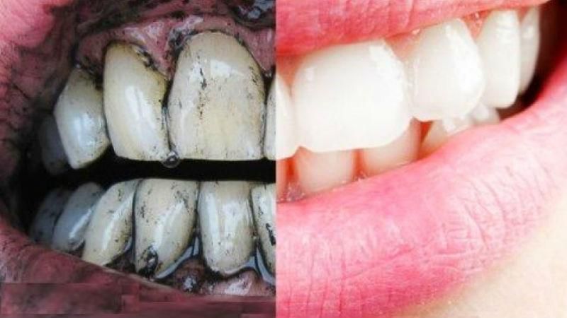 Стоматолог рассказал, почему опасно отбеливать зубы дома