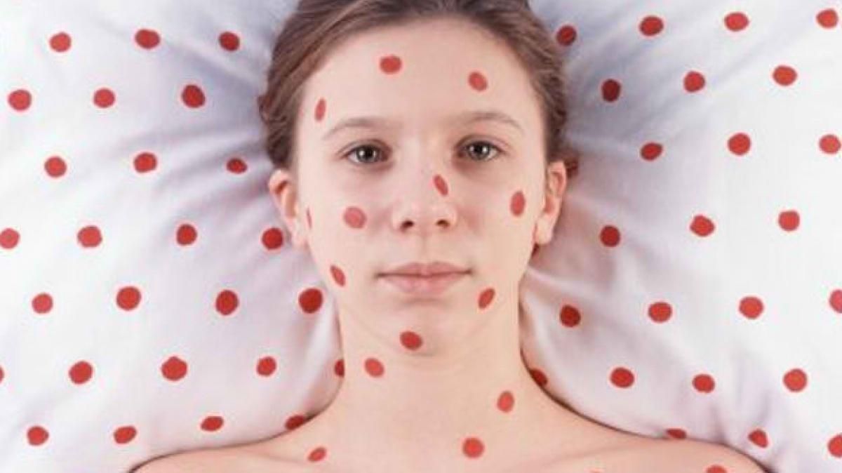 В Минздраве рассказали, в каких областях больше всего людей заболело корью В Минздраве рассказали, в каких областях больше всего людей заболело корью