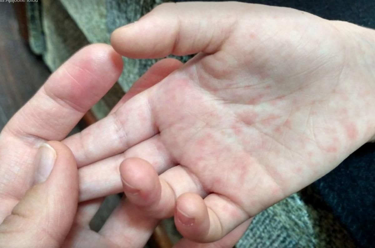 Епідемія кору в Україні: цьогоріч захворіли понад 9 тисяч людей