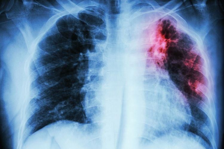 В Минздраве внедряют новые альтернативные методы диагностики туберкулеза