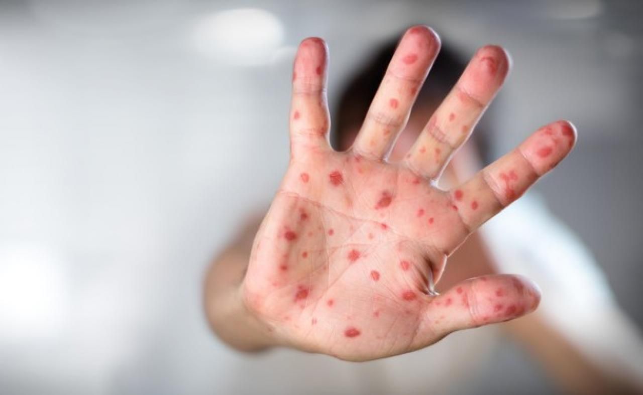 За останній тиждень в Україні різко зросла захворюваність на кір, – МОЗ За останній тиждень в Україні різко зросла захворюваність на кір, – МОЗ