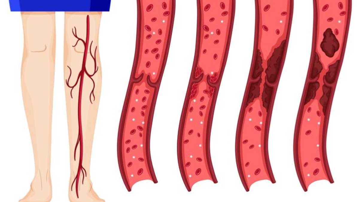 9 опасных признаков тромбоза, которые нельзя игнорировать - Здоровье 24