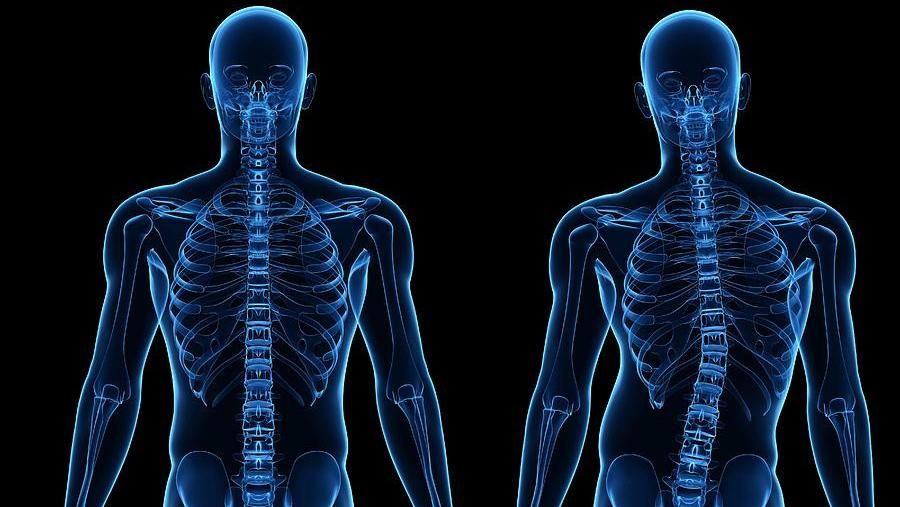 Что делать со сколиозом: советы педагога Что делать со сколиозом: советы педагога