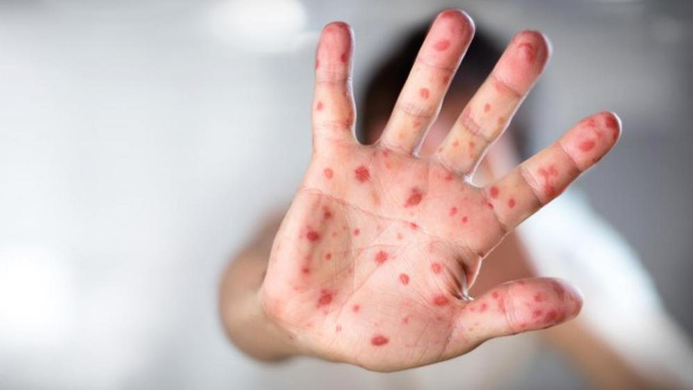 В Украине ожидается мощная эпидемия кори