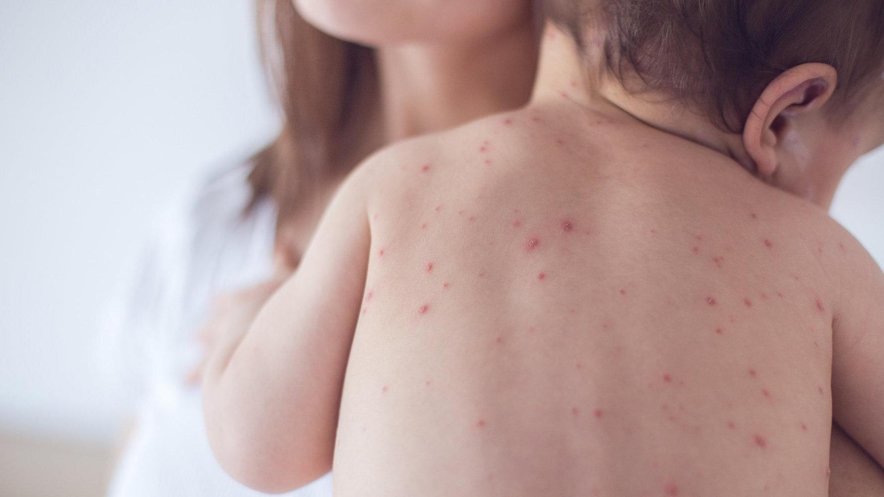 В Одессе от кори умер 10-месячный ребенок