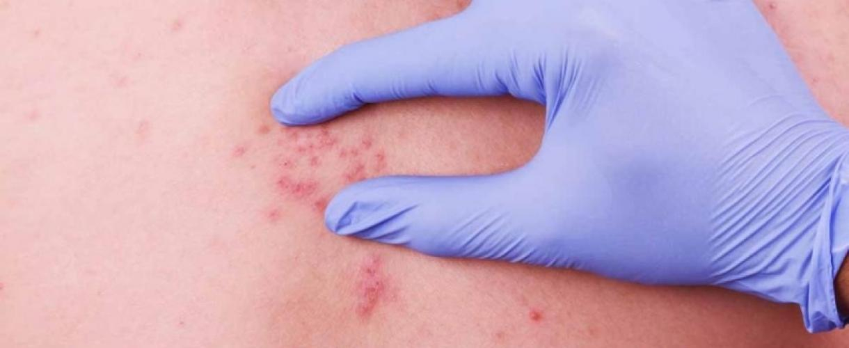 Украинец вернулся с Бали, привезя редкую болезнь