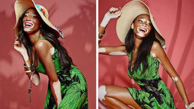 Болезнь Майкла Джексона: опасное ли неизлечимое витилиго