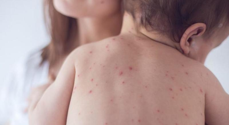 За прошедшую неделю корью в Украине заболел 1021 человек, – МОЗ